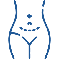 ابدومینوپلاستی